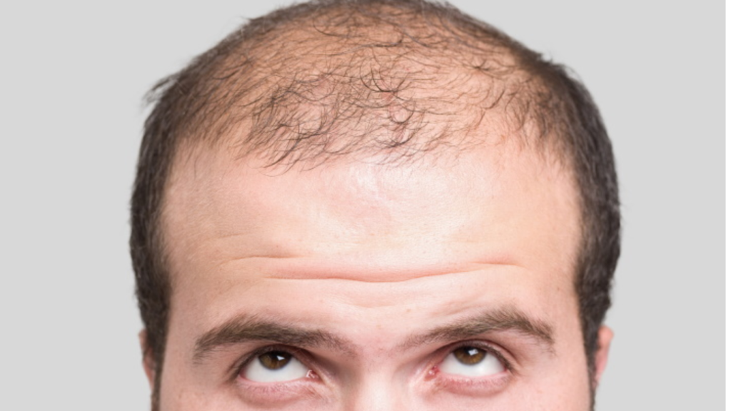 Hair loss